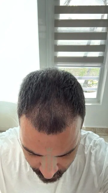 Before & After 221 Hair transplant result, 4,200 grafts, Month 3 — Hair of Istanbul