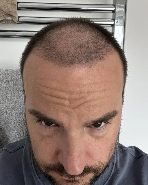 Before & After 232 Hair transplant result, 4,100 grafts, Month 3 — Hair of Istanbul