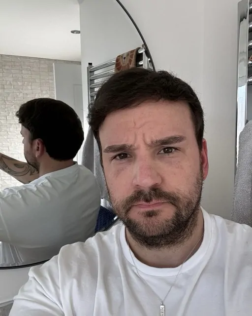 Before & After 233 Hair transplant result, 4,100 grafts, Month 12 — Hair of Istanbul