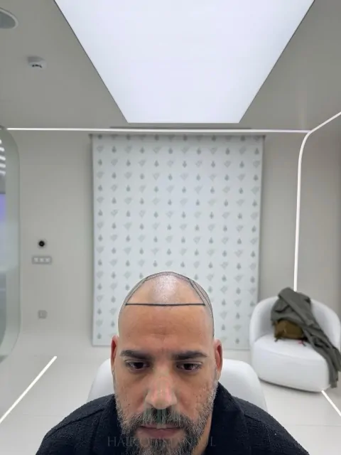 Before & After 219 Hair transplant result, 4,200 grafts, Hairline design — Hair of Istanbul