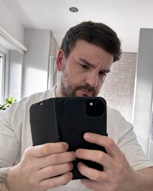 Before & After 234 Hair transplant result, 4,100 grafts, Month 12 (2) — Hair of Istanbul