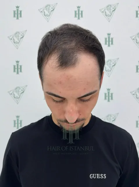 Before & After 251 Hair transplant result, 3,100 grafts, Before — Hair of Istanbul