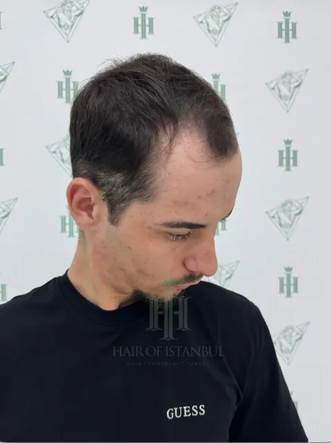 Before & After 252 Hair transplant result, 3,100 grafts, Before (2) — Hair of Istanbul
