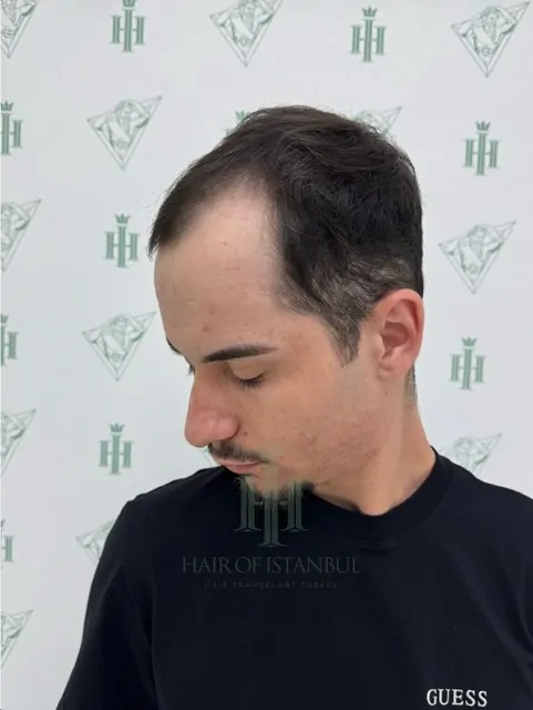 Before & After 253 Hair transplant result, 3,100 grafts, Before (3) — Hair of Istanbul