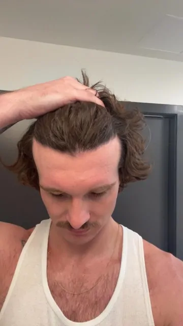Before & After 245 Hair transplant result, 2,500 grafts, Month 15 — Hair of Istanbul