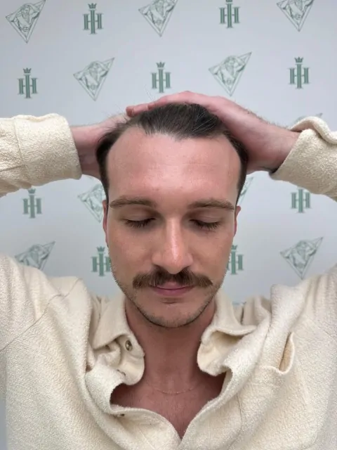 Before & After 237 Hair transplant result, 2,500 grafts, Before — Hair of Istanbul