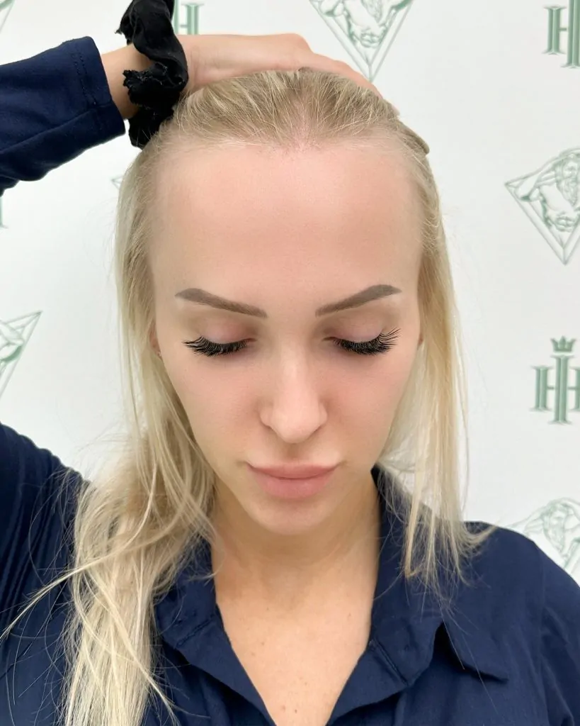 Before & After 311 Women’s hair transplant result, 2,000 grafts, Before — Hair of Istanbul