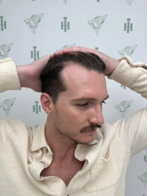 Before & After 238 Hair transplant result, 2,500 grafts, Before (2) — Hair of Istanbul