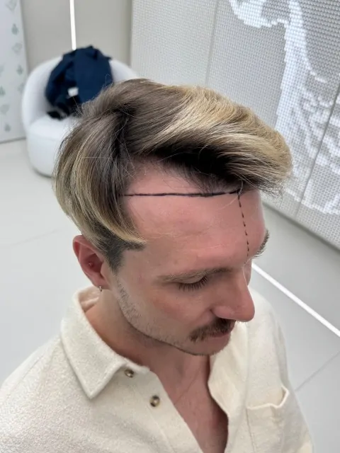 Before & After 239 Hair transplant result, 2,500 grafts, Before (3) — Hair of Istanbul
