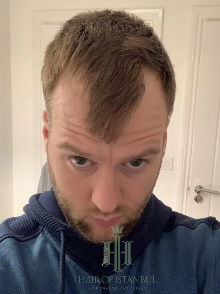 Before & After 264 Hair transplant result, 2,700 grafts, Before — Hair of Istanbul