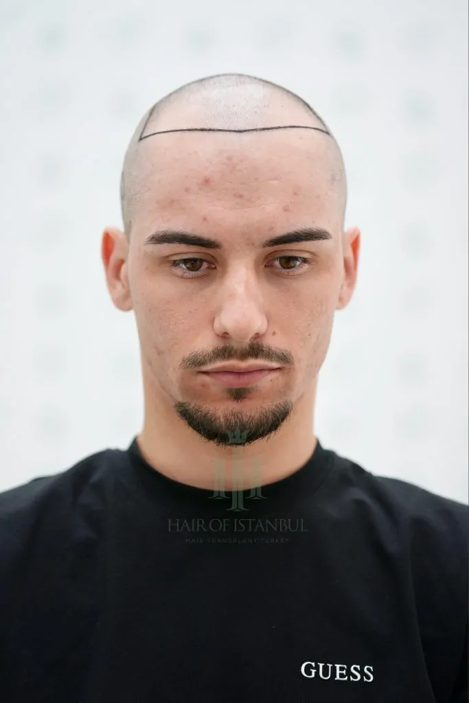 Before & After 256 Hair transplant result, 3,100 grafts, Hairline design (3) — Hair of Istanbul
