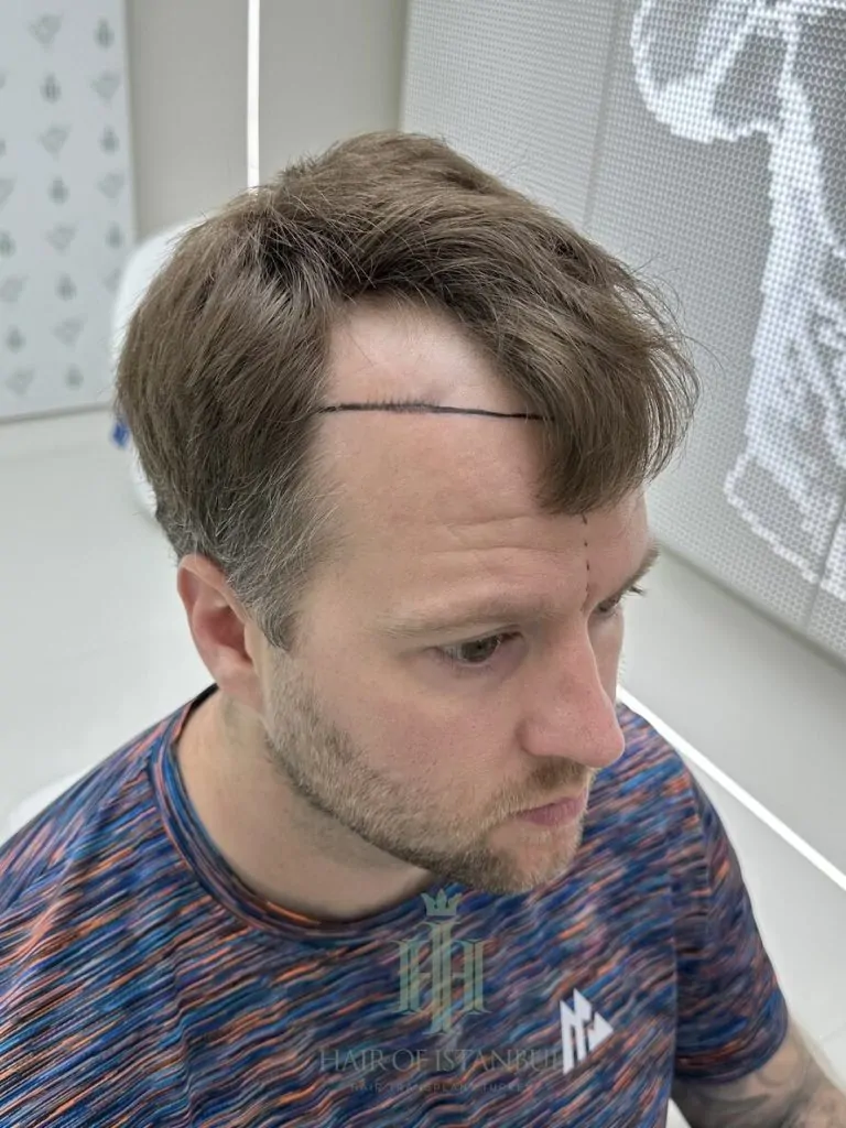 Before & After 266 Hair transplant result, 2,700 grafts, Hairline design (2) — Hair of Istanbul