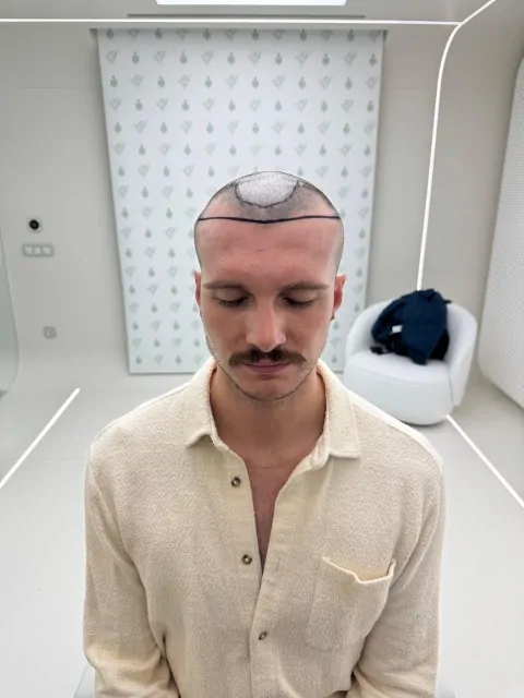 Before & After 240 Hair transplant result, 2,500 grafts, Hairline design — Hair of Istanbul
