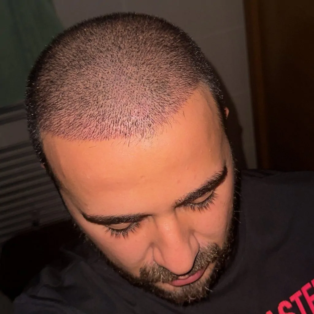 Before & After 282 Hair transplant result, 4,500 grafts, Day 10 — Hair of Istanbul