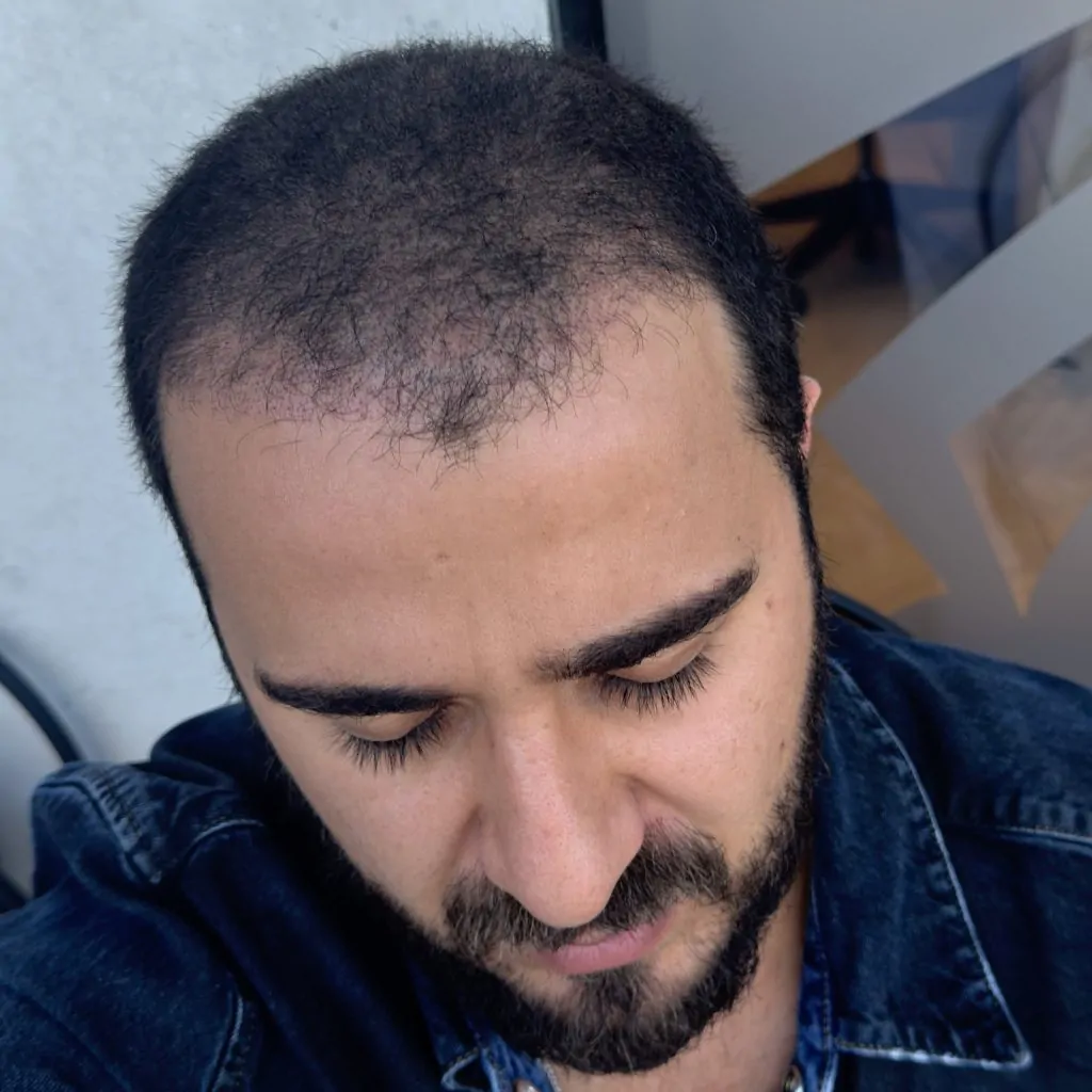 Before & After 283 Hair transplant result, 4,500 grafts, Month 1 — Hair of Istanbul