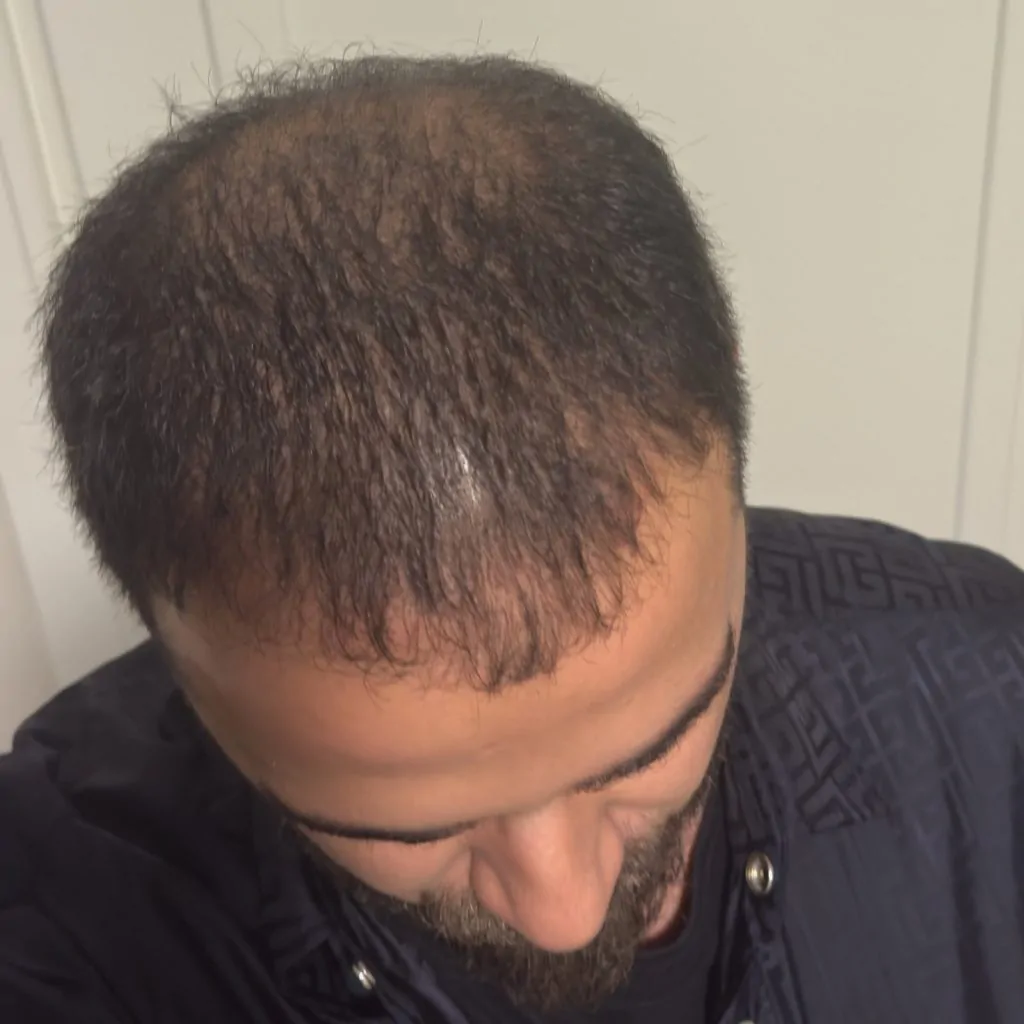 Before & After 284 Hair transplant result, 4,500 grafts, Before & After — Hair of Istanbul