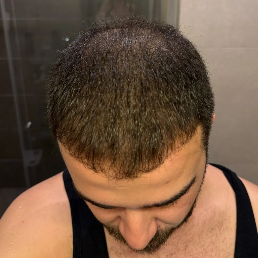 Before & After 286 Hair transplant result, 4,500 grafts, Month 4 — Hair of Istanbul