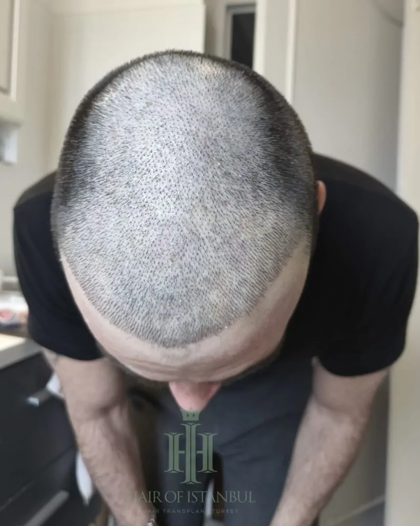 Before & After 134 Hair transplant result, 4,550 grafts, Day 10 — Hair of Istanbul