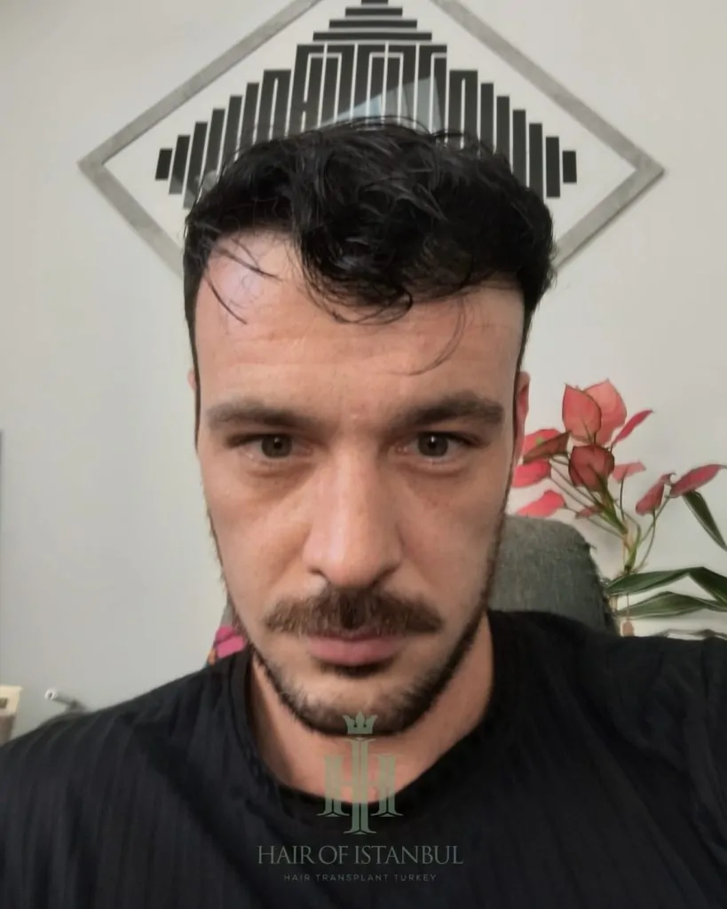 Before & After 139 Hair transplant result, 4,550 grafts, Month 12 (3) — Hair of Istanbul