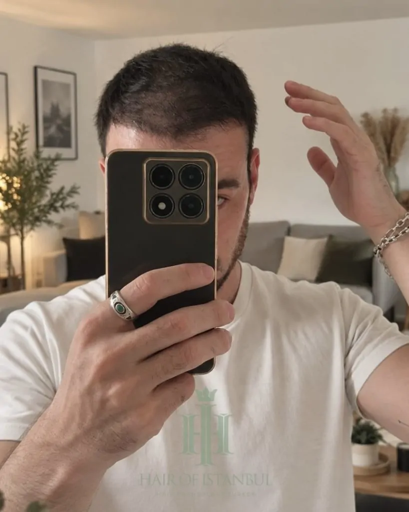 Before & After 136 Hair transplant result, 4,550 grafts, Month 4 — Hair of Istanbul