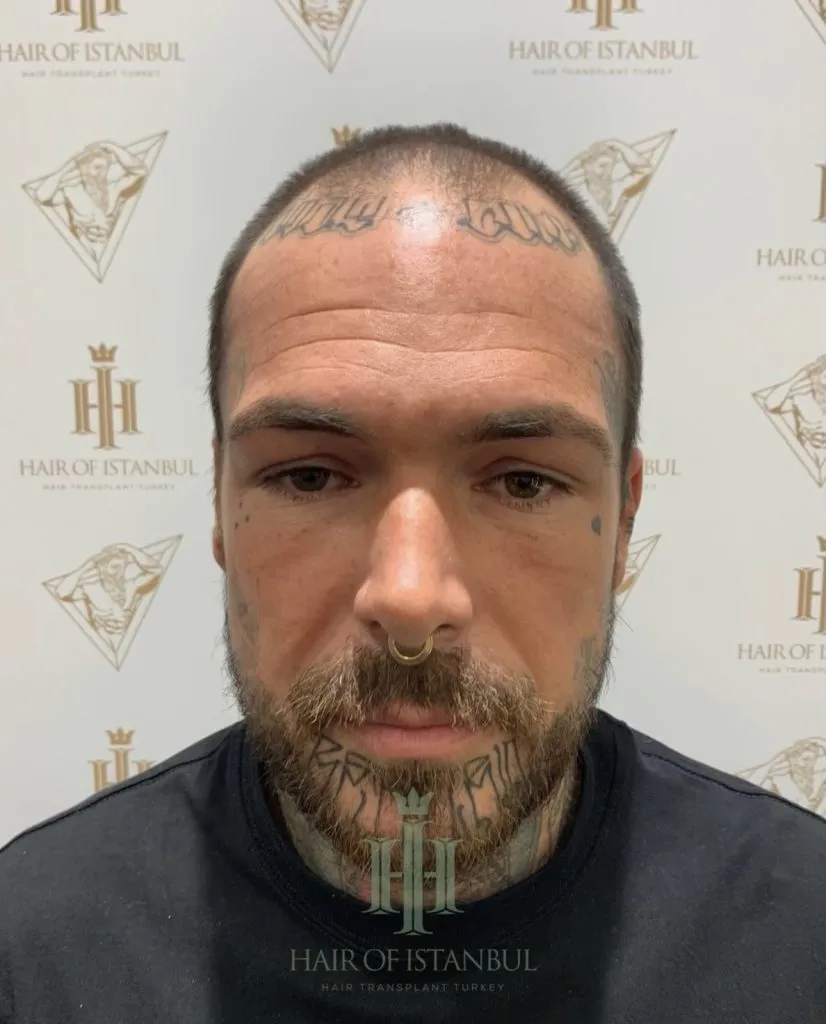 Before & After 157 Hair transplant result, 4,900 grafts, Before — Hair of Istanbul