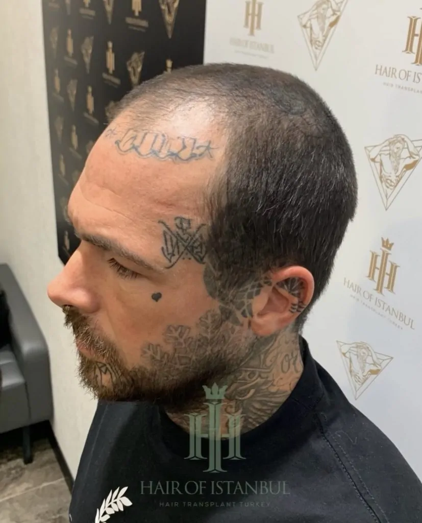 Before & After 159 Hair transplant result, 4,900 grafts, Before (3) — Hair of Istanbul