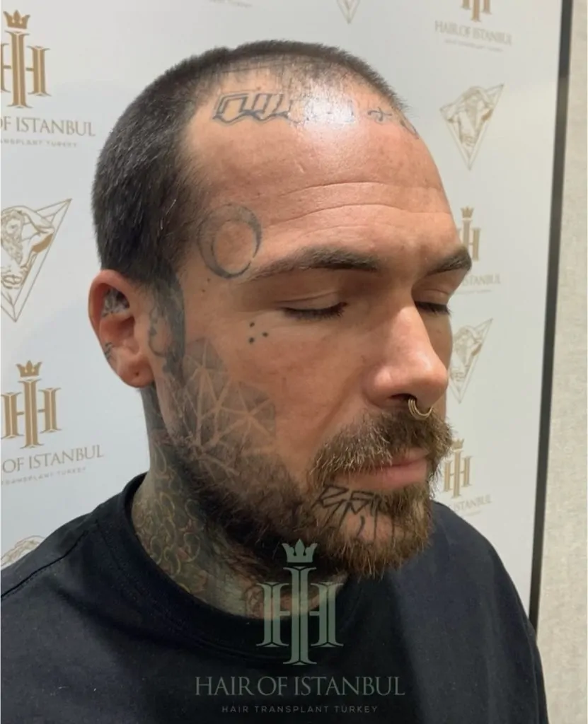 Before & After 160 Hair transplant result, 4,900 grafts, Before (4) — Hair of Istanbul