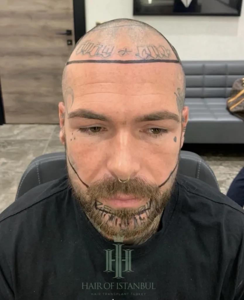 Before & After 161 Hair transplant result, 4,900 grafts, Hairline design — Hair of Istanbul