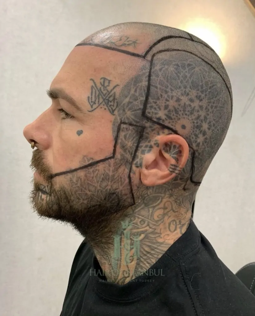 Before & After 162 Hair transplant result, 4,900 grafts, Hairline design (2) — Hair of Istanbul