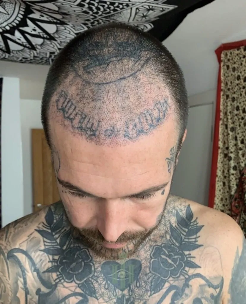 Before & After 163 Hair transplant result, 4,900 grafts, Month 3 — Hair of Istanbul