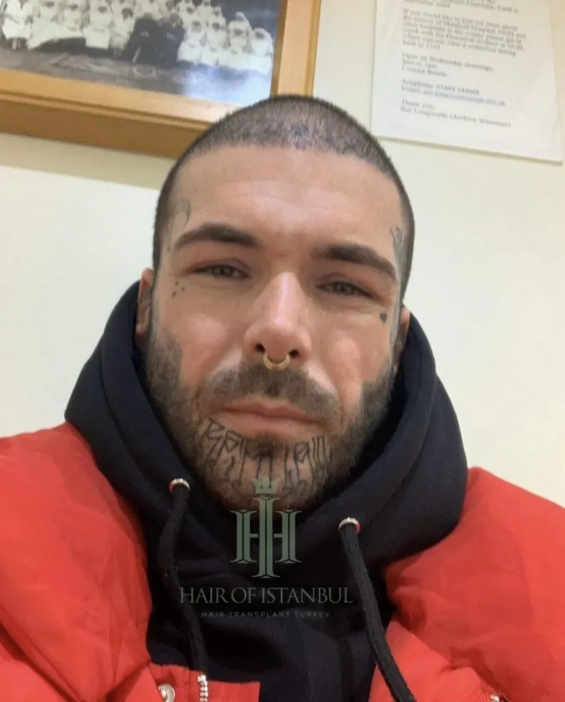 Before & After 164 Hair transplant result, 4,900 grafts, Month 4 — Hair of Istanbul