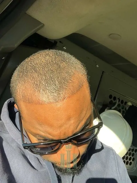 Before & After 174 Hair transplant result, 3,400 grafts, Month 1 — Hair of Istanbul