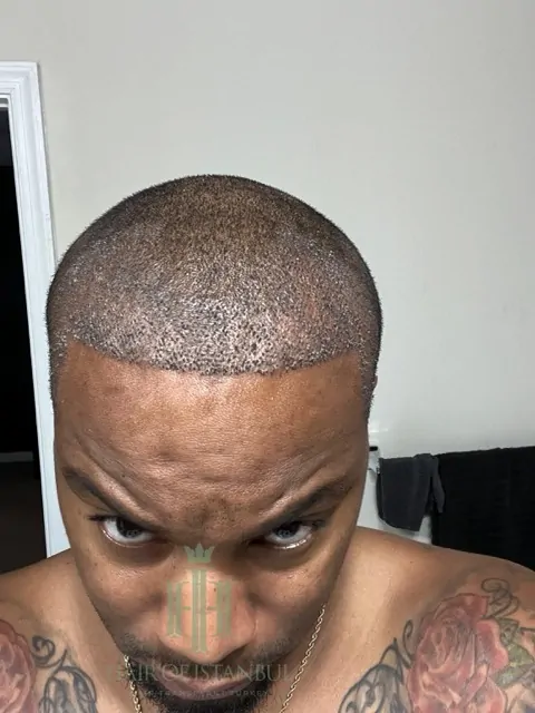 Before & After 172 Hair transplant result, 3,400 grafts, Day 3 — Hair of Istanbul