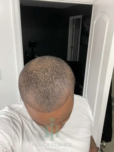 Before & After 173 Hair transplant result, 3,400 grafts, Day 10 — Hair of Istanbul