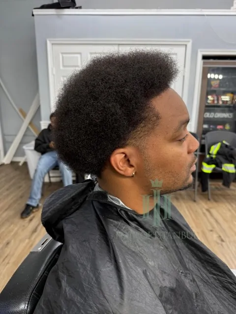 Before & After 176 Hair transplant result, 3,400 grafts, Month 15 — Hair of Istanbul