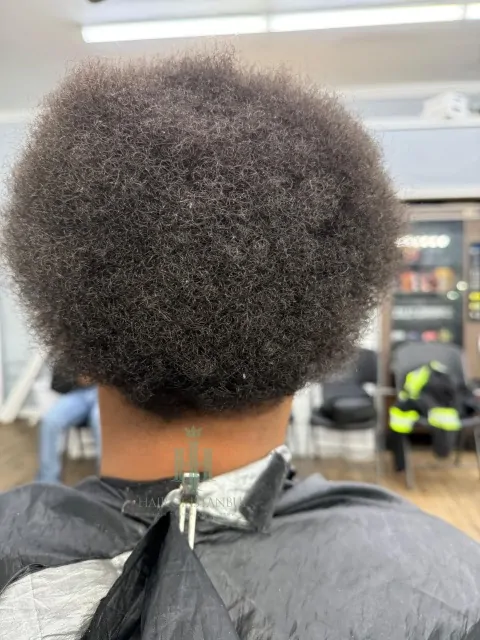 Before & After 175 Hair transplant result, 3,400 grafts, Donor area — Hair of Istanbul