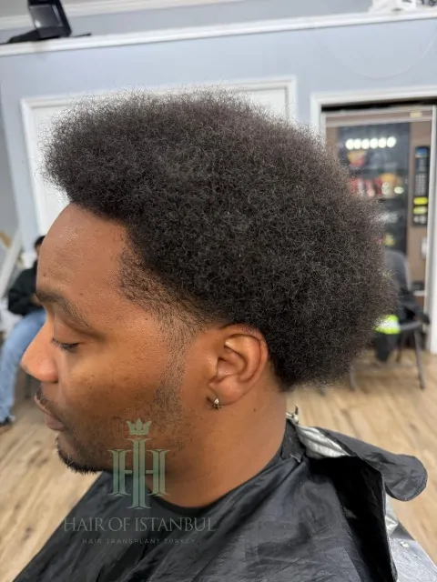 Before & After 177 Hair transplant result, 3,400 grafts, Month 15 (2) — Hair of Istanbul