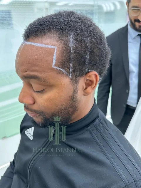 Before & After 167 Hair transplant result, 3,400 grafts, Before — Hair of Istanbul
