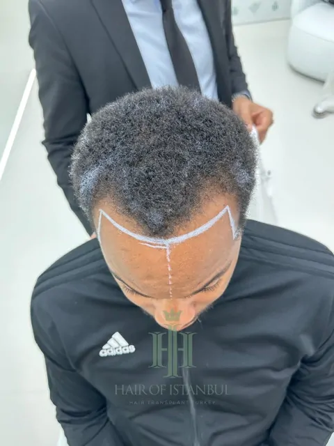 Before & After 168 Hair transplant result, 3,400 grafts, Before (2) — Hair of Istanbul