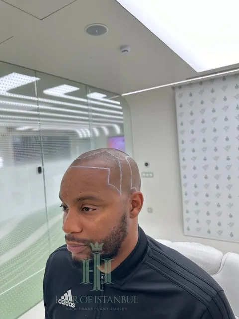 Before & After 169 Hair transplant result, 3,400 grafts, Hairline design — Hair of Istanbul