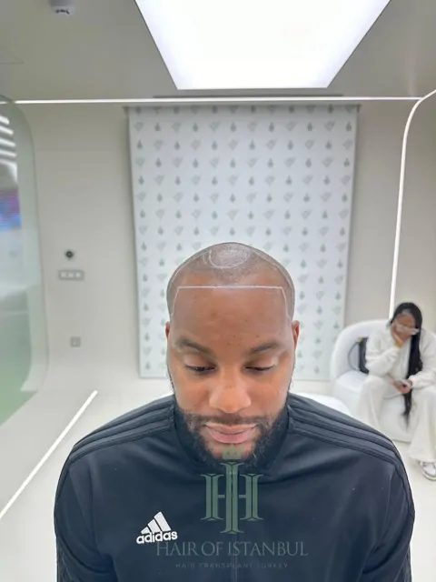 Before & After 171 Hair transplant result, 3,400 grafts, Hairline design (3) — Hair of Istanbul