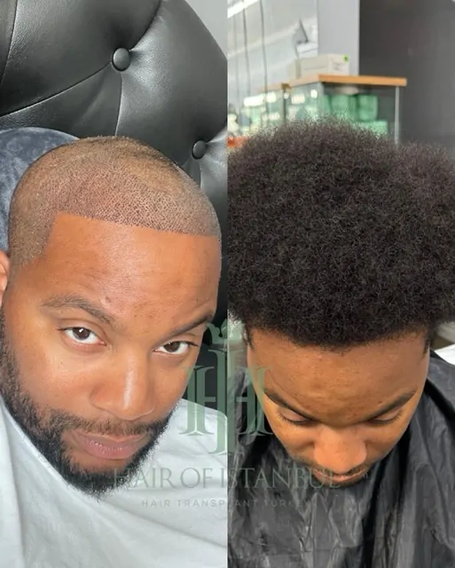 Before & After 166 Hair transplant result, 3,400 grafts, Before & After — Hair of Istanbul