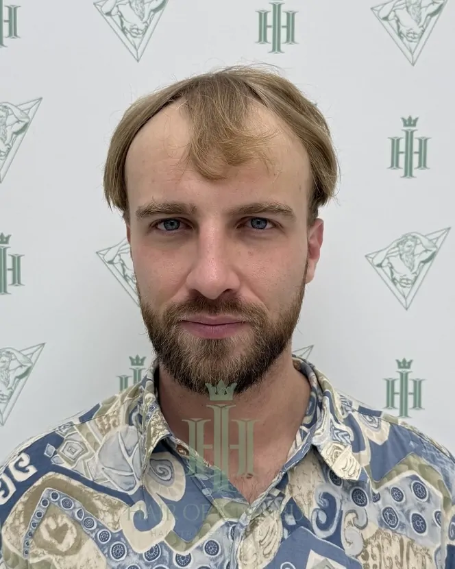 Before & After 144 Hair transplant result, 4,150 grafts, Before (2) — Hair of Istanbul