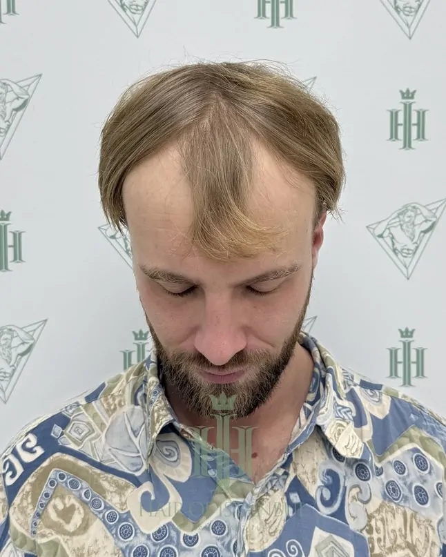 Before & After 143 Hair transplant result, 4,150 grafts, Before — Hair of Istanbul