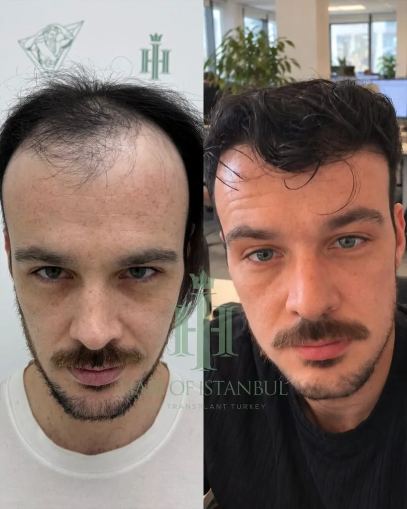 Before & After 124 Hair transplant result, 4,550 grafts, Before & After — Hair of Istanbul