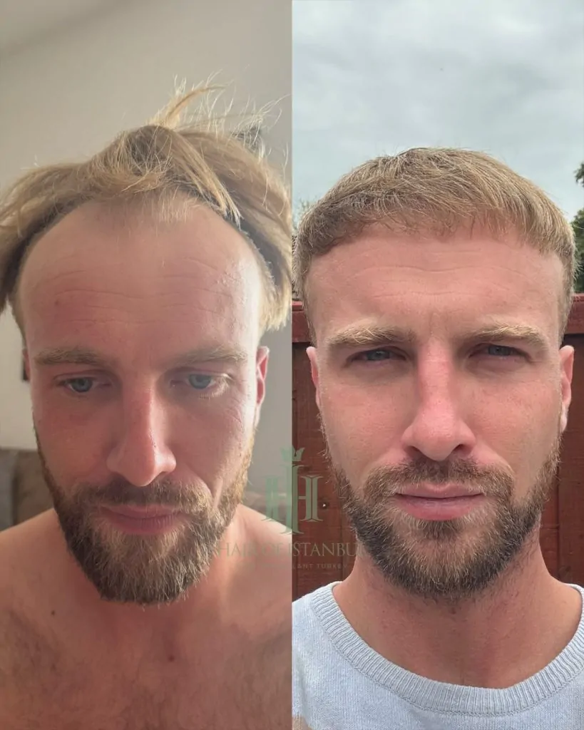 Before & After 142 Hair transplant result, 4,150 grafts, Before & After — Hair of Istanbul