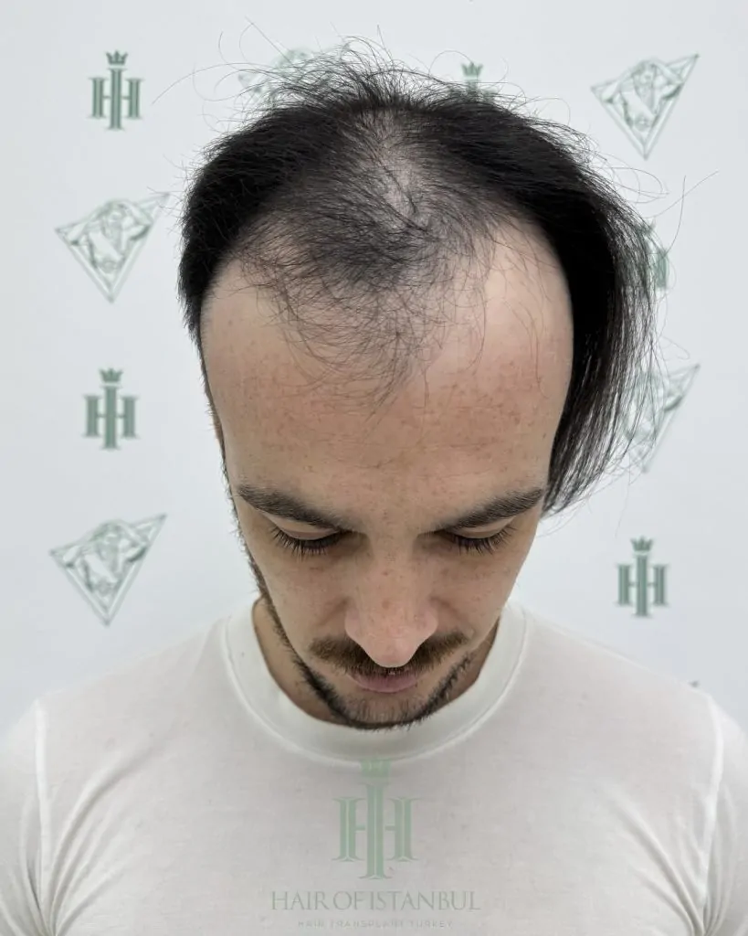 Before & After 125 Hair transplant result, 4,550 grafts, Before — Hair of Istanbul