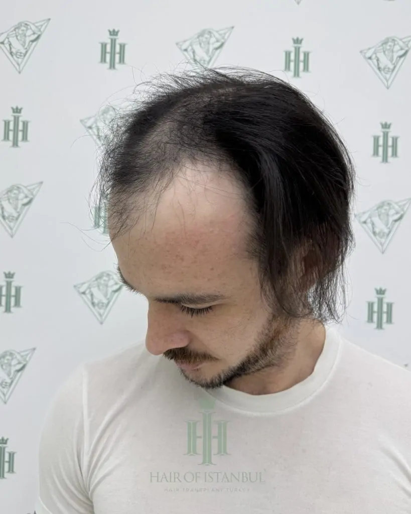 Before & After 126 Hair transplant result, 4,550 grafts, Before (2) — Hair of Istanbul