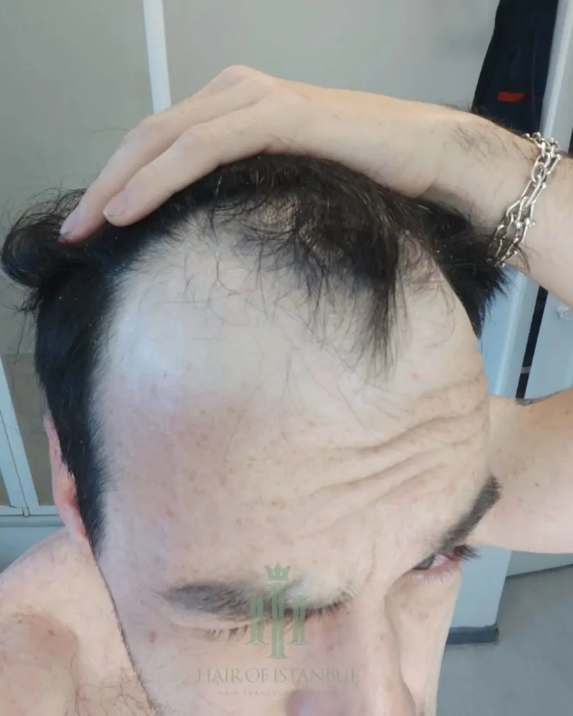 Before & After 129 Hair transplant result, 4,550 grafts, Before (5) — Hair of Istanbul