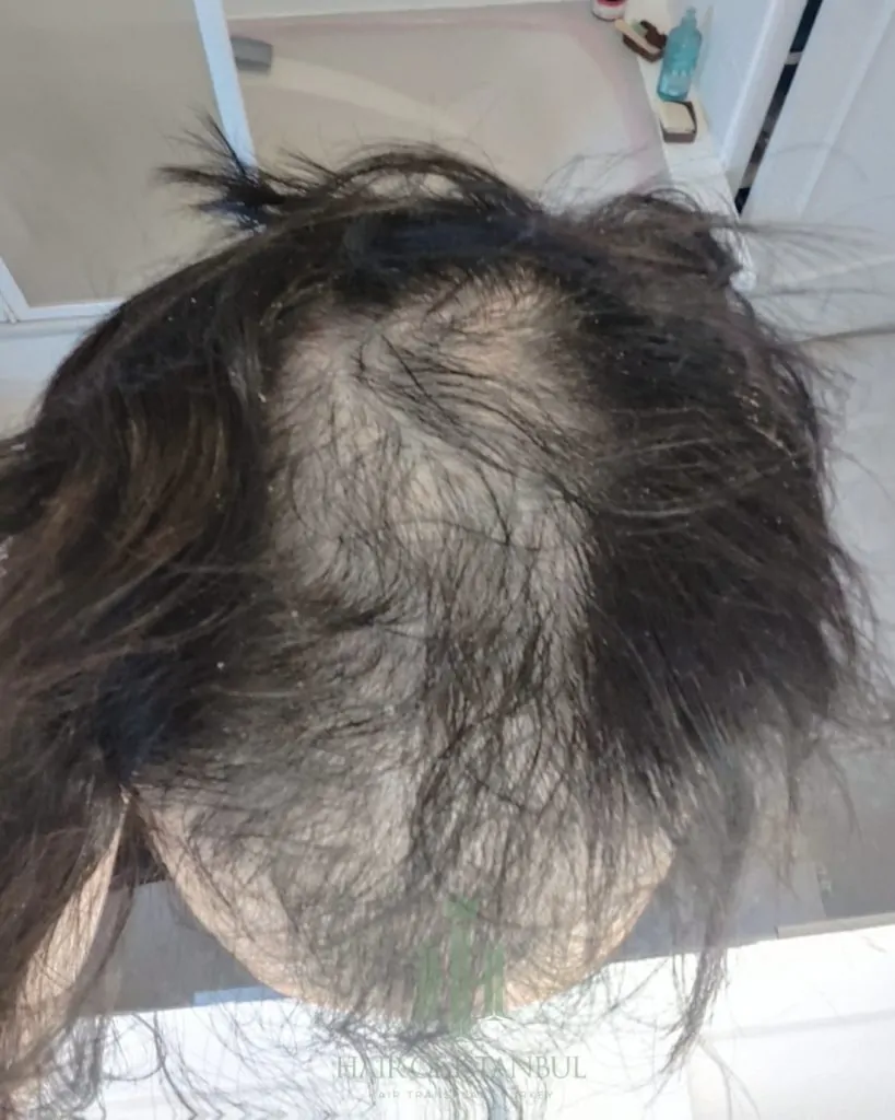 Before & After 130 Hair transplant result, 4,550 grafts, Before (6) — Hair of Istanbul